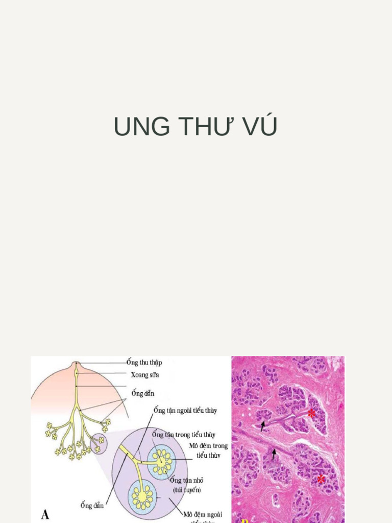 Ung Thu Vu Slide VUTM | PDF