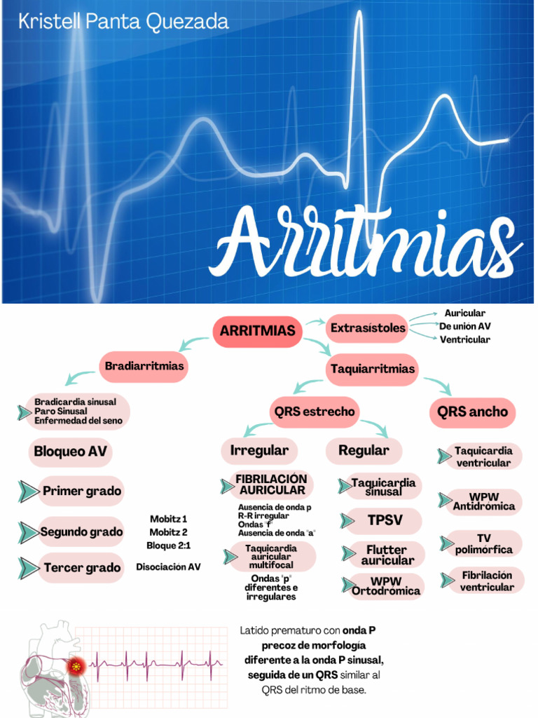 Arritmias | PDF