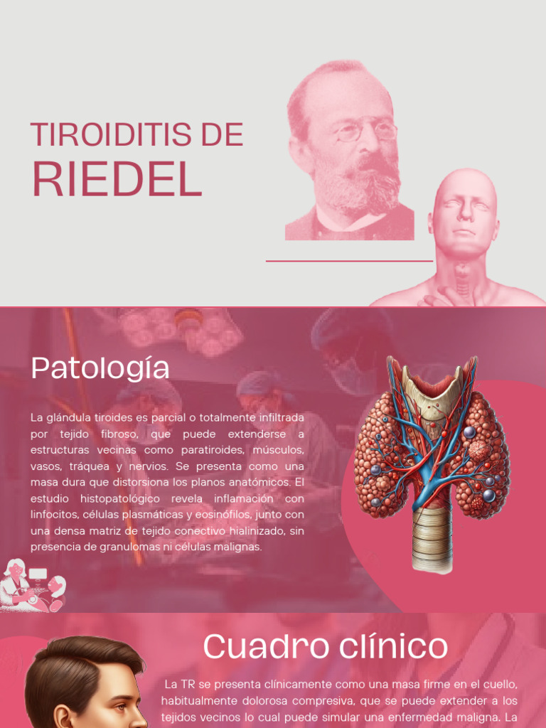 Tiroiditis: Diagnóstico y Características | PDF