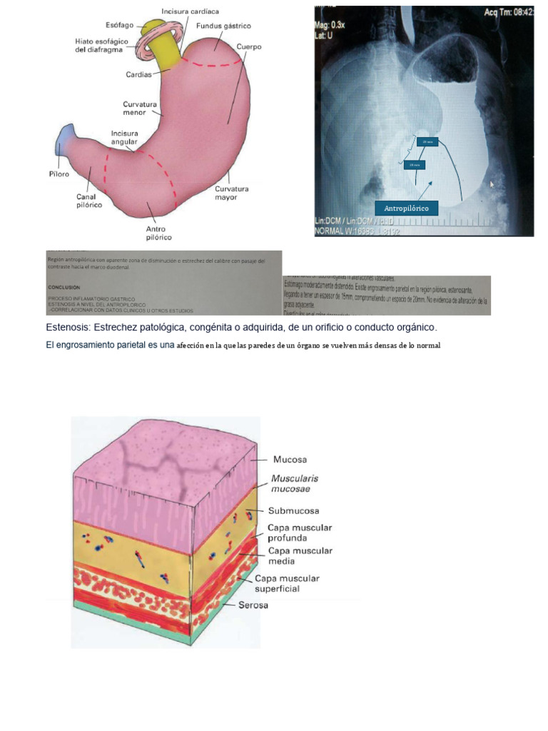 Estenosis Pilorica | PDF | Sistema digestivo | Gastroenterología