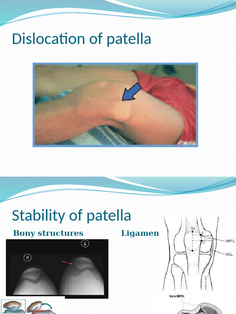 Dislocation of Patella, 14th Jan 2014 | PDF