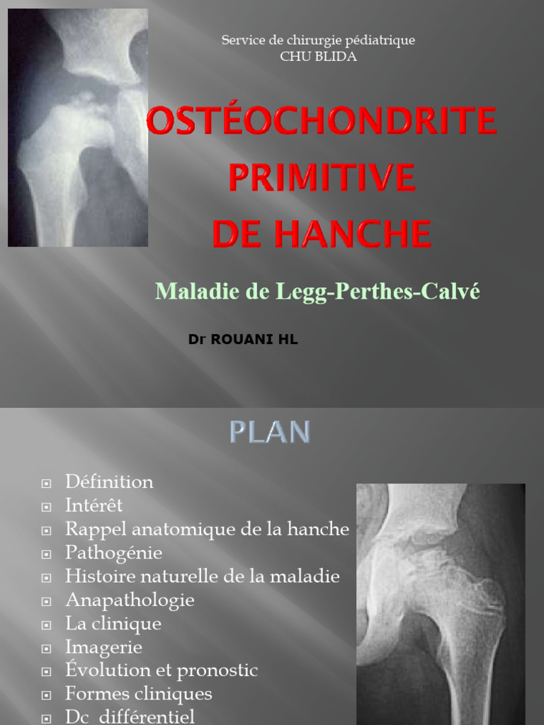 Maladie de Legg-Perthes chez l'enfant | PDF | Arthrose | Os