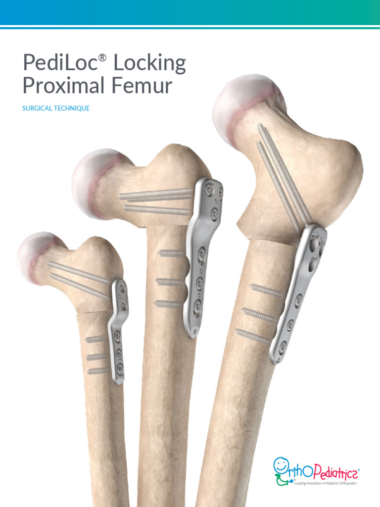 ST 0907-01-00 Rev D PediLoc Locking Proximal Femur 2022 Updatev3 | PDF ...