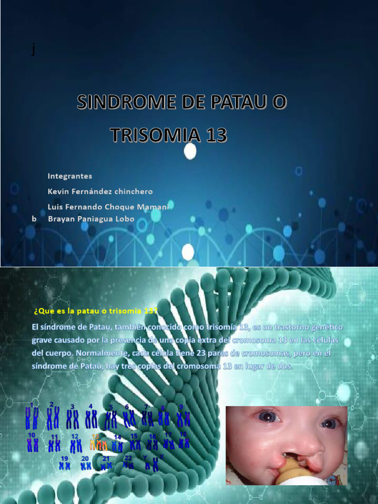 Trisomía 13: Síndrome de Patau Explicado | PDF