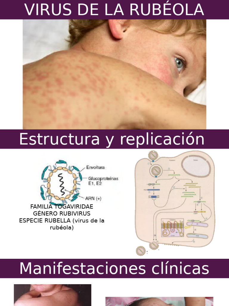 Virus de la Rubéola: Síntomas y Diagnóstico | PDF