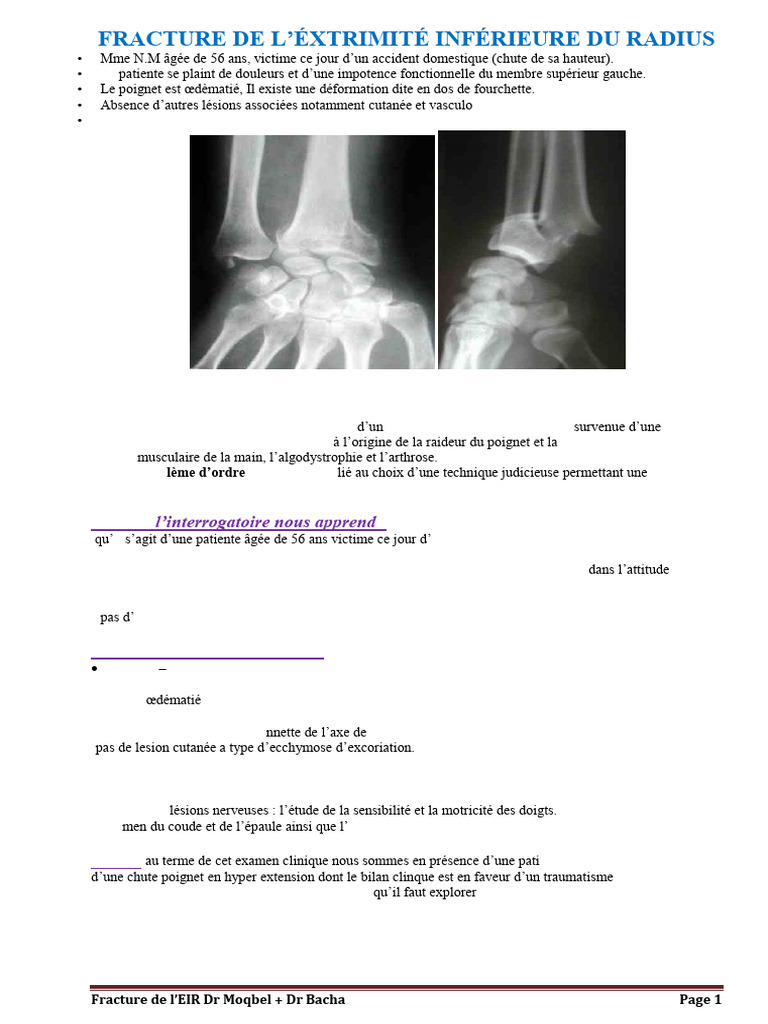 Fracture complexe de l'EIR au poignet | PDF | Articulation (anatomie ...