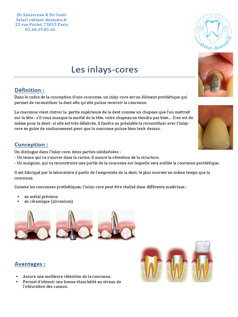 Définition et avantages de l'inlay-core | PDF | Matériaux | Branches de ...