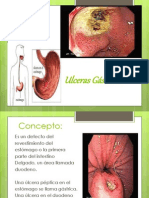 Ulceras Gastriicas