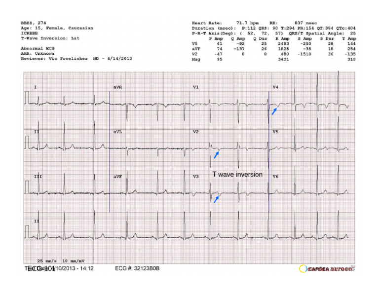 Understanding T Wave Inversion in ECG | PDF
