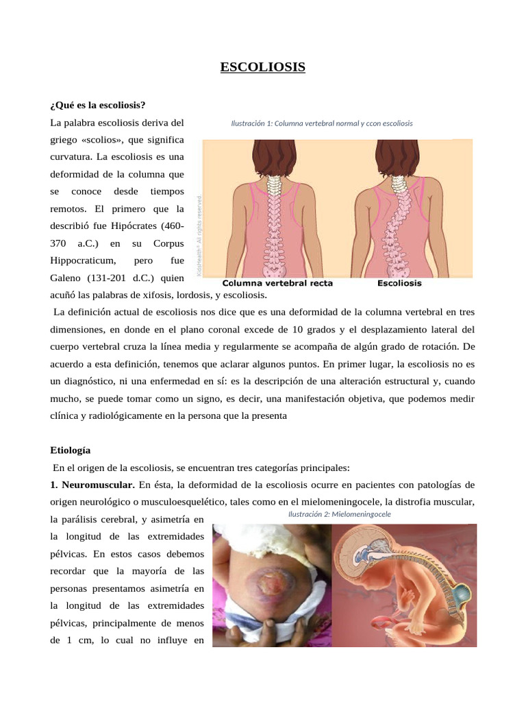 Signos y tratamiento de la escoliosis | PDF | Escoliosis | Terapia física
