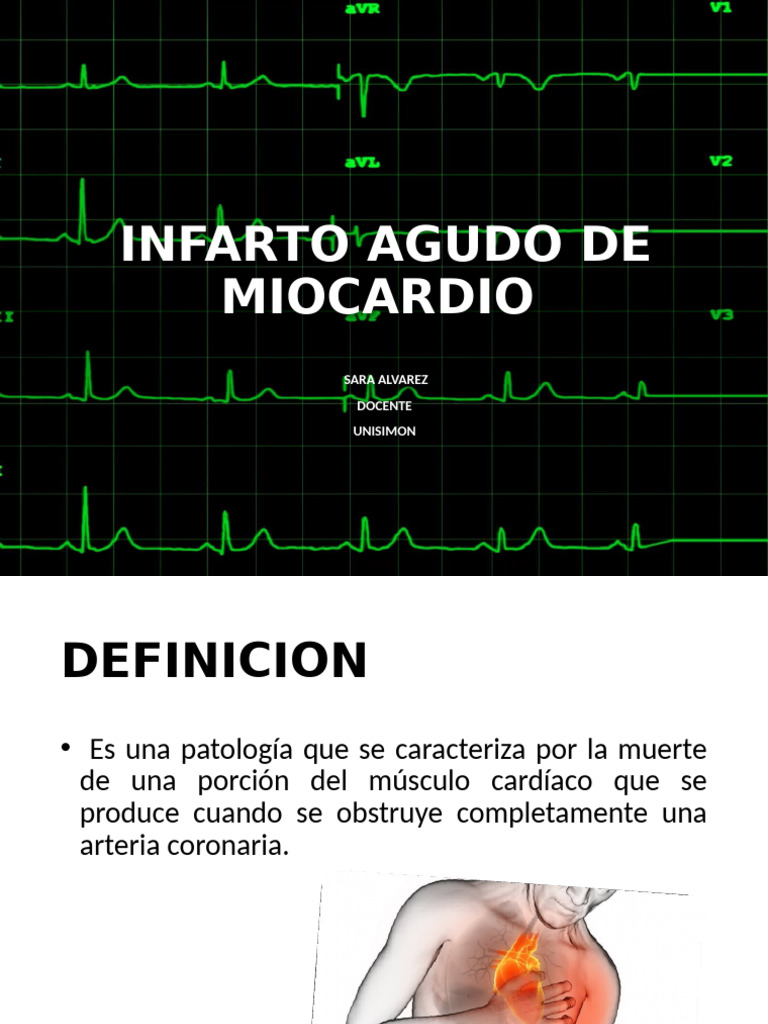 Infarto Agudo de Miocardio | PDF | Infarto de miocardio | Enfermedades ...