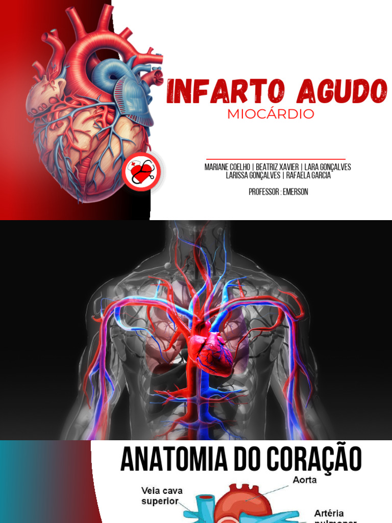 Infarto Agudo do Miocárdio: Sintomas e Tratamento | PDF