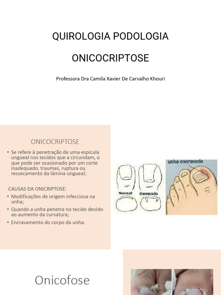 Onicocriptose: Causas e Tratamentos | PDF | Dor | Unha