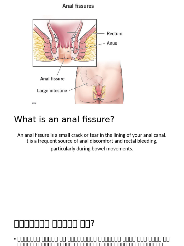 Anal Fissure | PDF