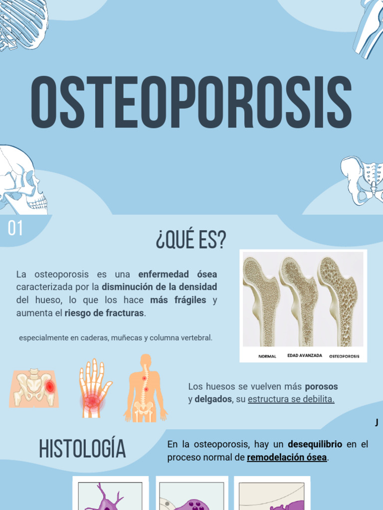 Guía Completa sobre la Osteoporosis | PDF | Hueso | Osteoporosis
