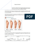 Tipos de Fracturas