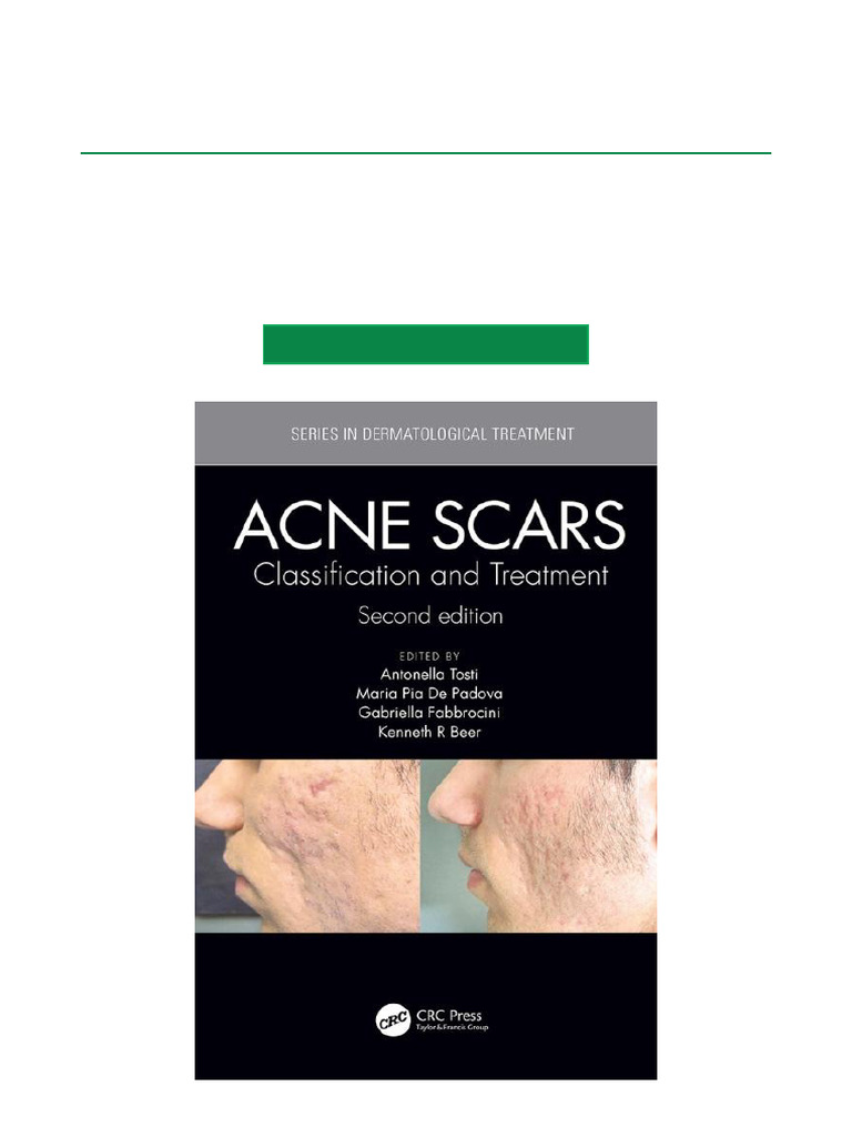 Acne Scars Classification and Treatment, Second Edition 2nd Edition ...