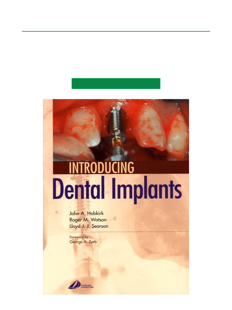 Introduction to Dental Implants | PDF | Dental Implant | Human Tooth