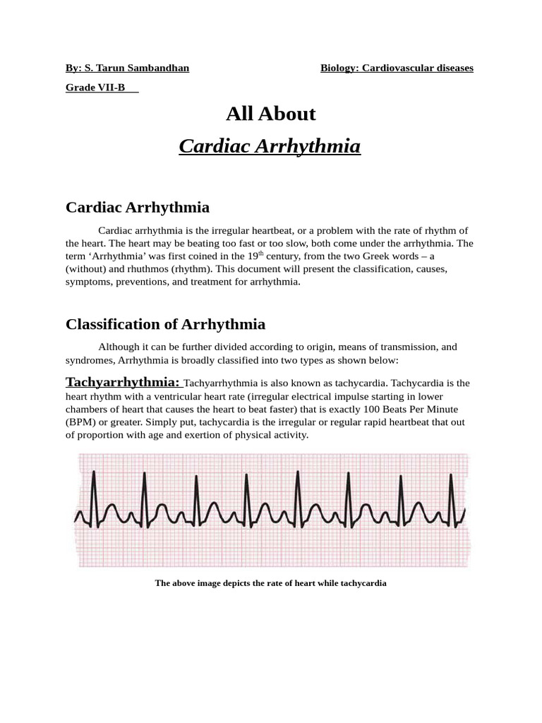 Understanding Cardiac Arrhythmia | PDF | Heart Rate | Heart