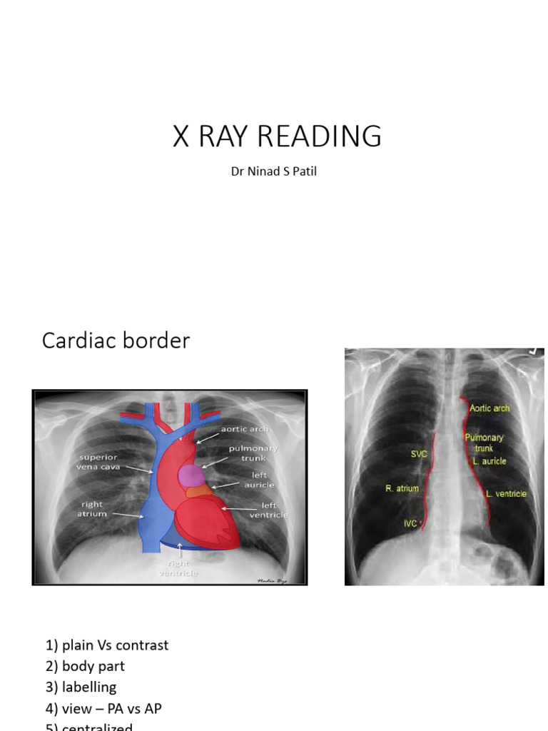 X-Ray Reading Guide for Cardiac and Lung Analysis | PDF | Ventricle ...