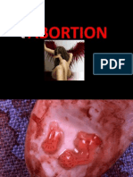 Abortion