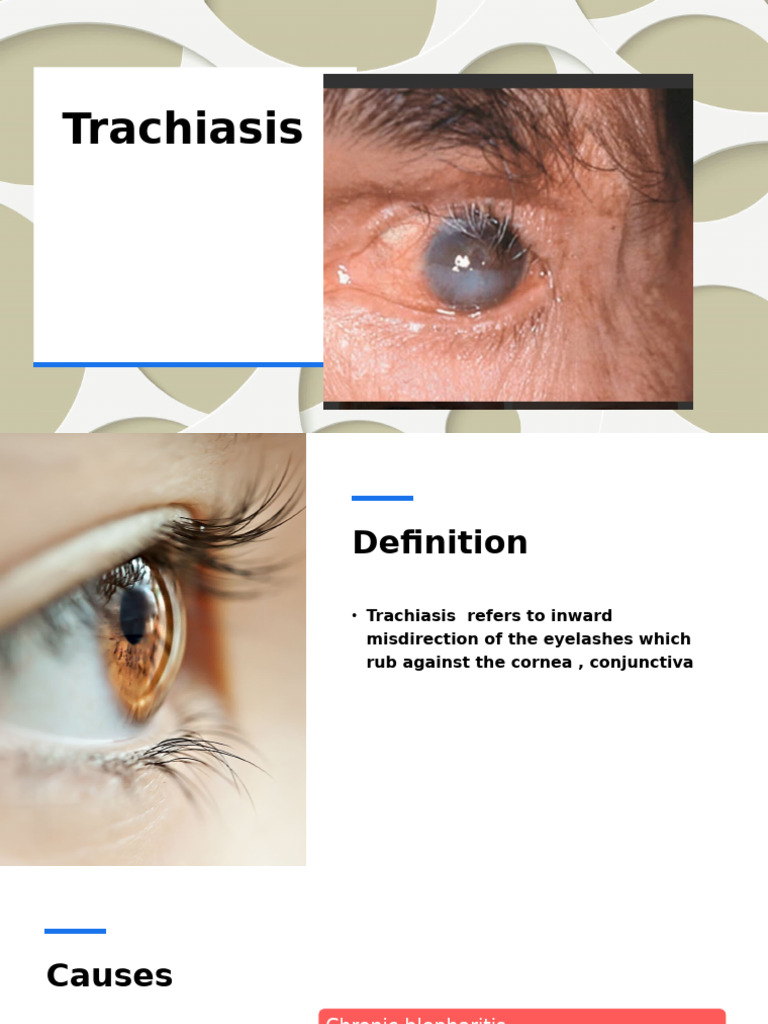 Understanding Trachiasis: Causes and Treatment | PDF