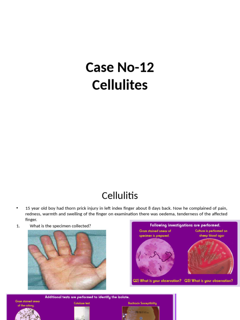 Cellulitis Case 12,13 &14 | PDF | Methicillin Resistant Staphylococcus ...