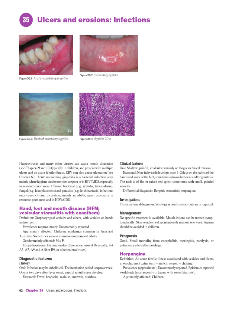 Understanding Chancres in Syphilis | PDF | Cutaneous Conditions ...