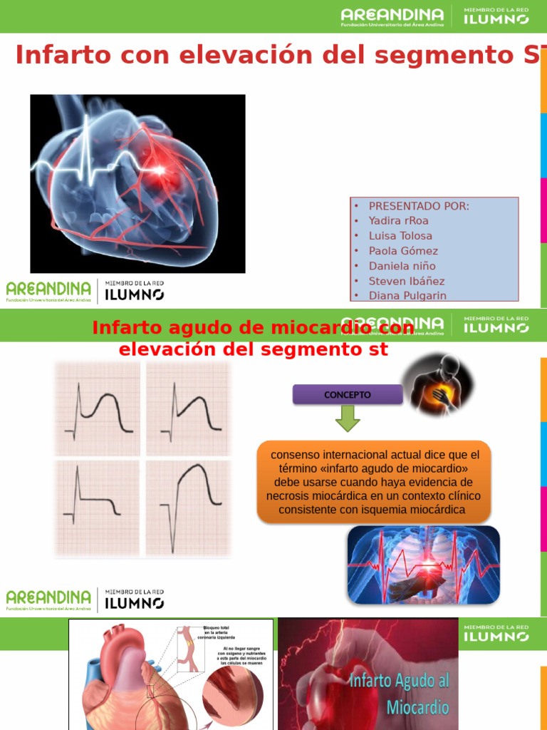 Infarto Agudo con Elevación ST | PDF | Infarto de miocardio ...