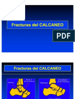 04- Fracturas Del Calcaneo