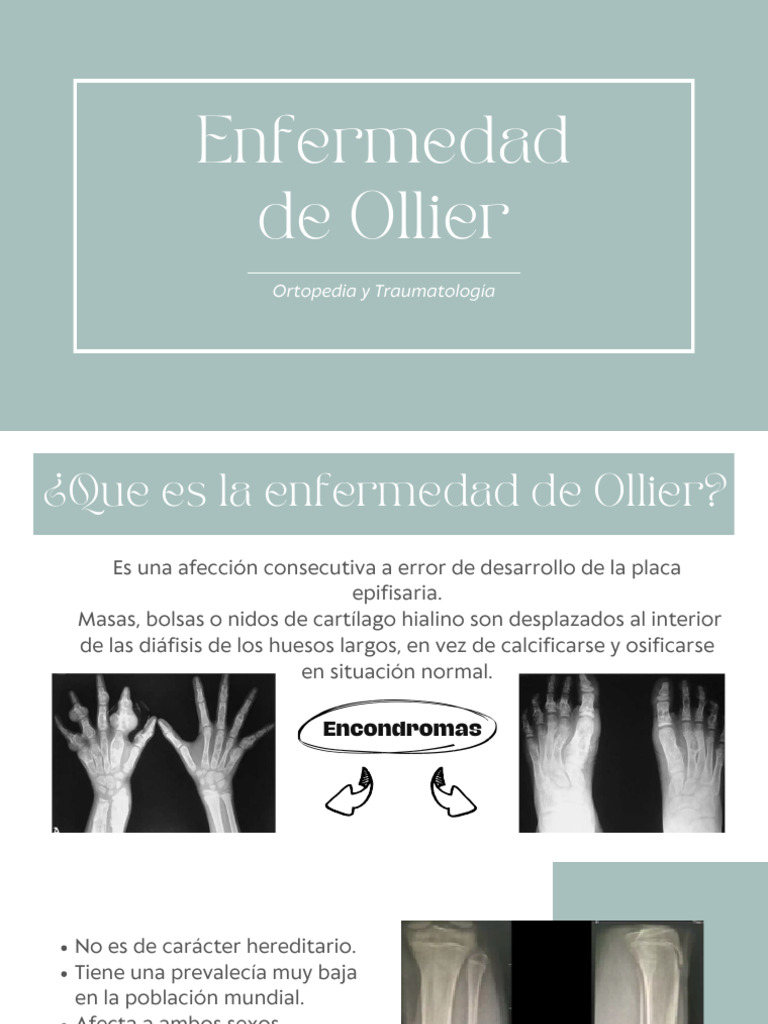 Canthoplastia en enfermedad de Ollier | PDF | Hueso | Traumatologia