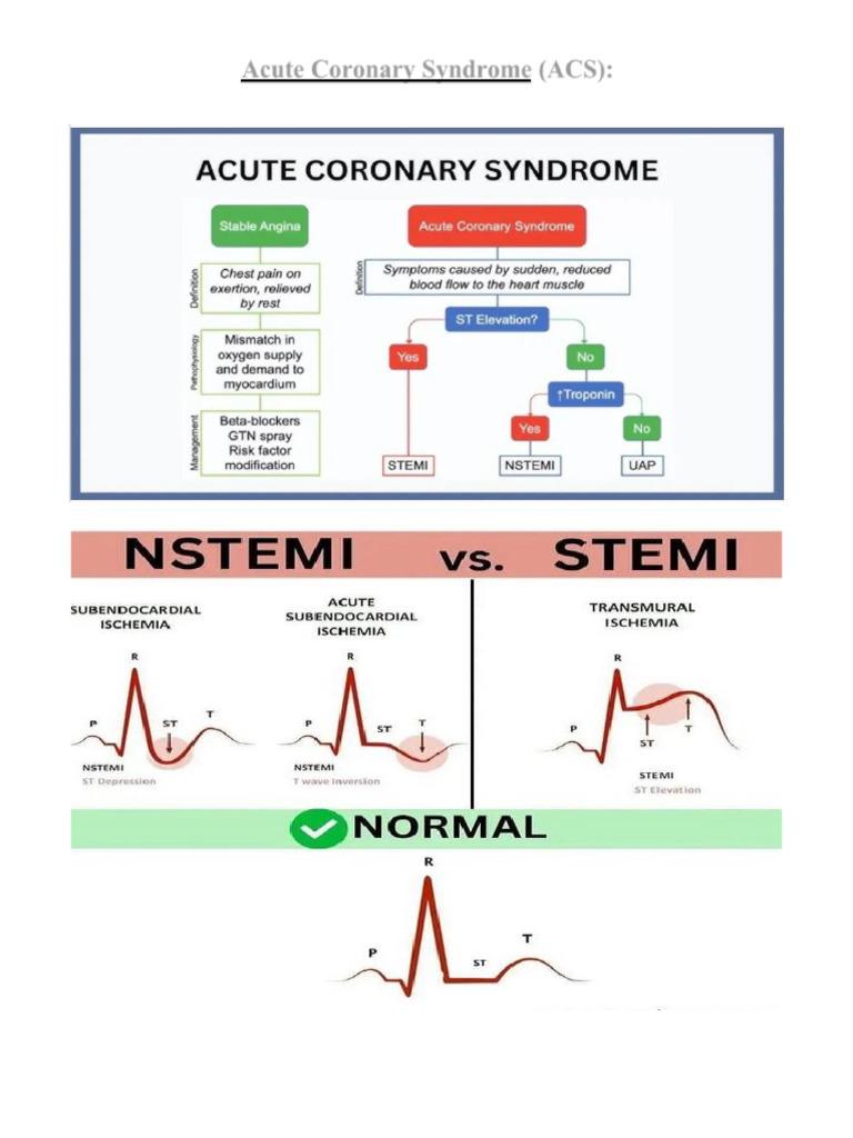 Understanding Acute Coronary Syndrome (ACS) | PDF | Myocardial ...