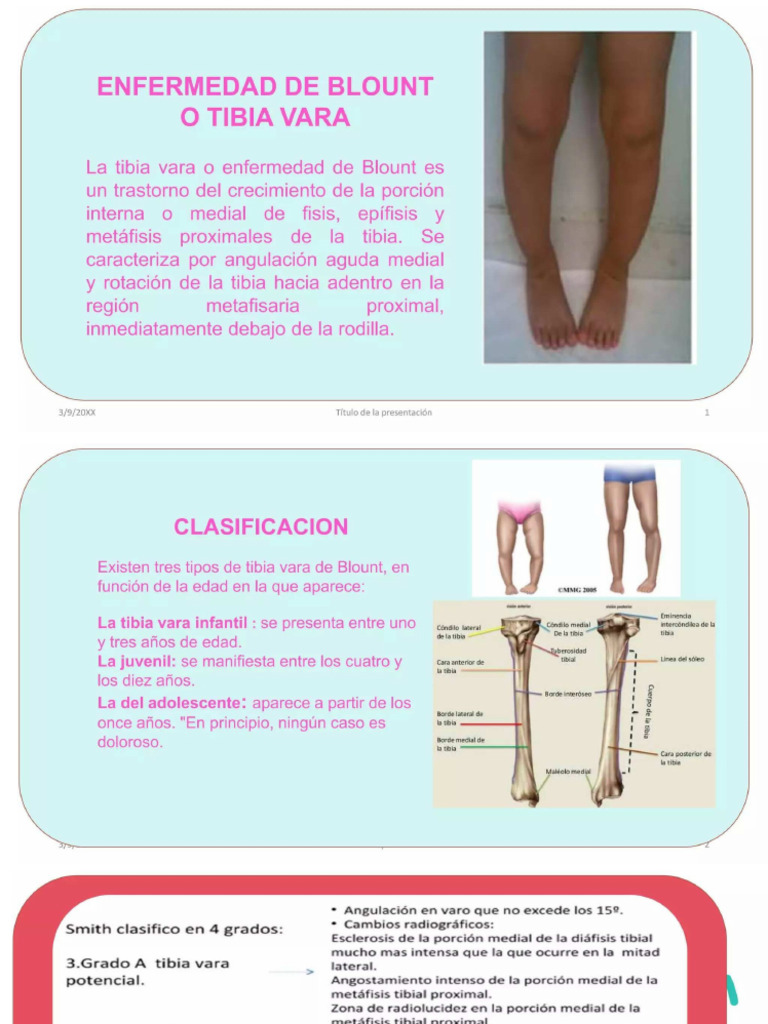 PDF Tibia Vara 3pptx | PDF