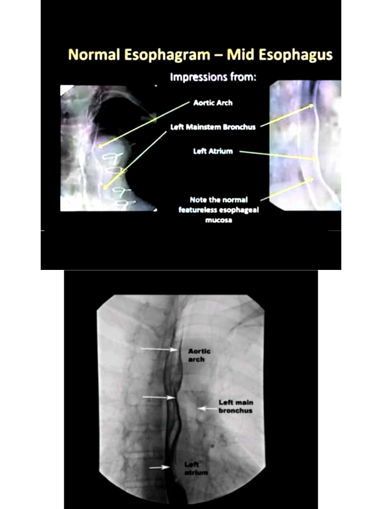 Radiological Images of The Esophagus | PDF