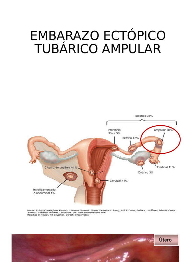 ANATOMÍA PATOLÓGICA EMBARAZO ECTÓPICO TUBÁRICO AMPULAR | PDF