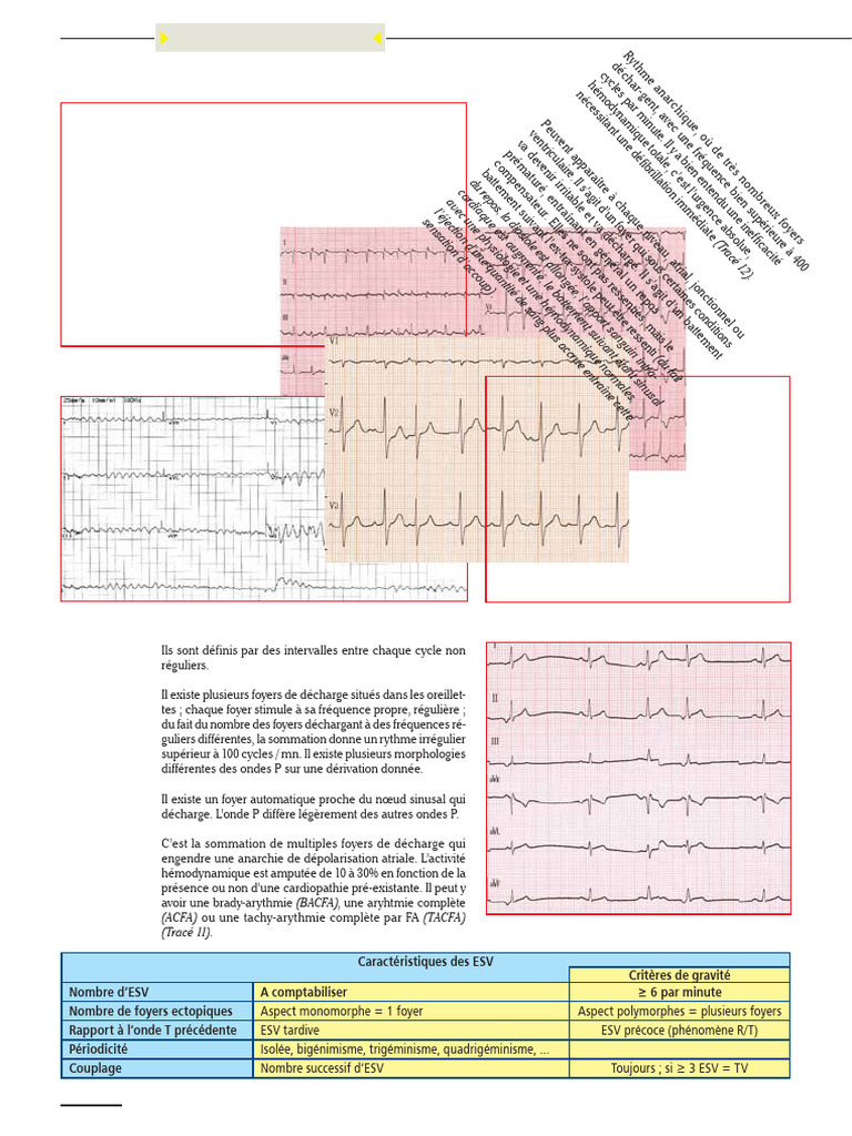 Troubles du rythme cardiaque et ESV | PDF | Électrocardiographie ...