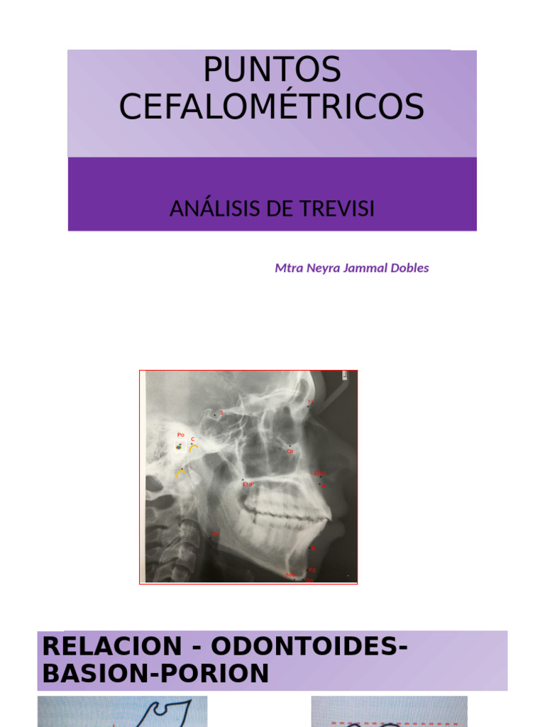 Análisis Cefalométrico de Trevisi | PDF