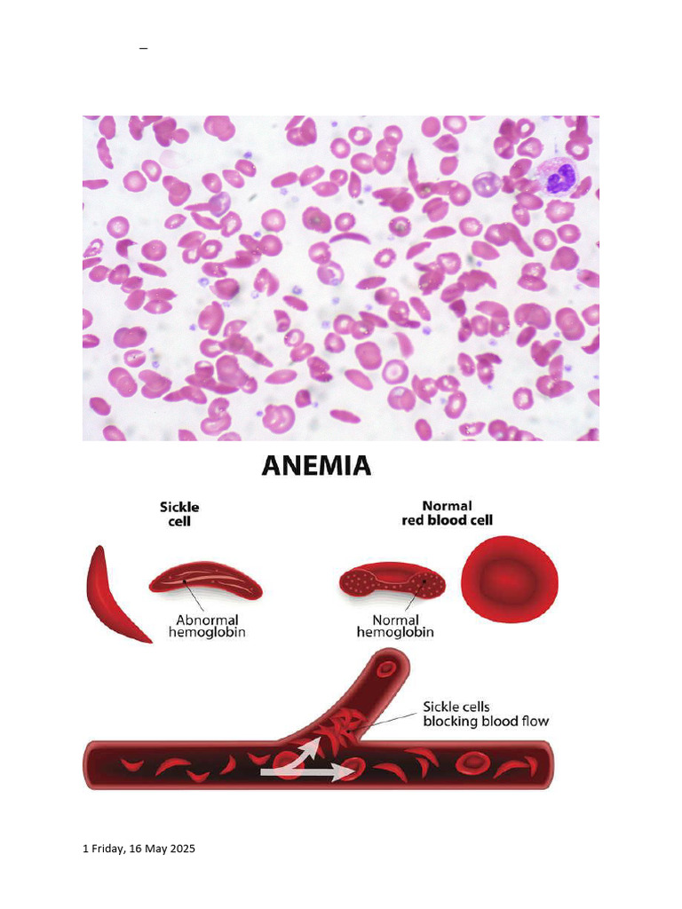 Sickle Cell Disease Lab Testing Guide | PDF | Hemoglobin | Hematology