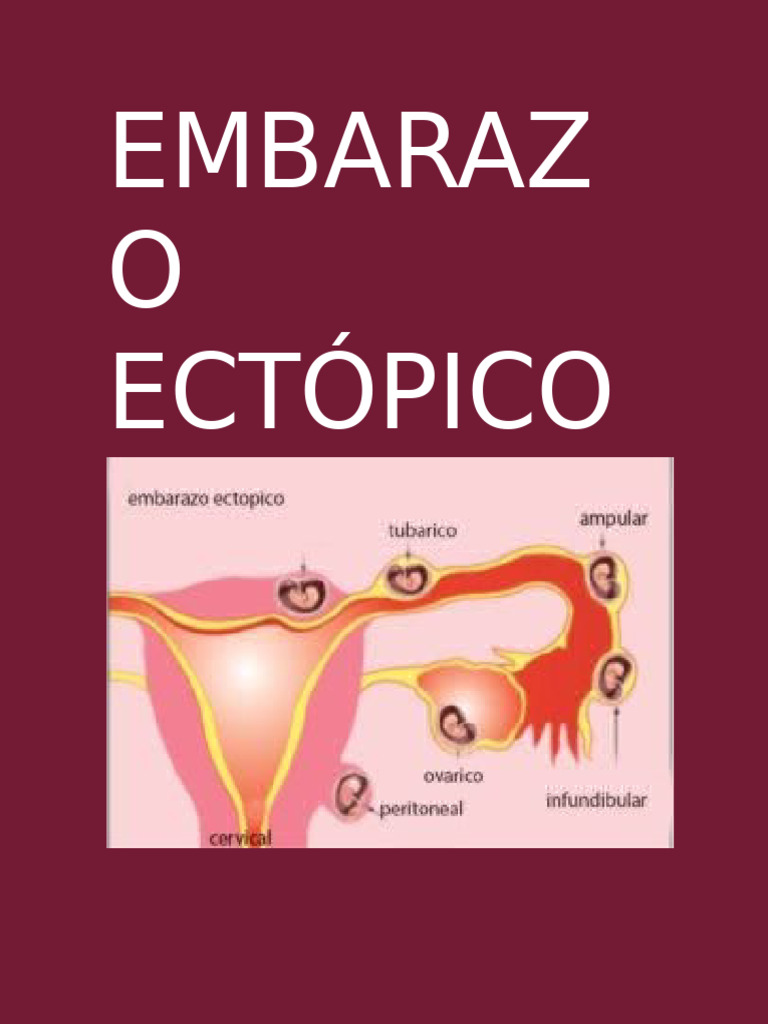 Embarazo Ectópico: Síntomas y Riesgos | PDF
