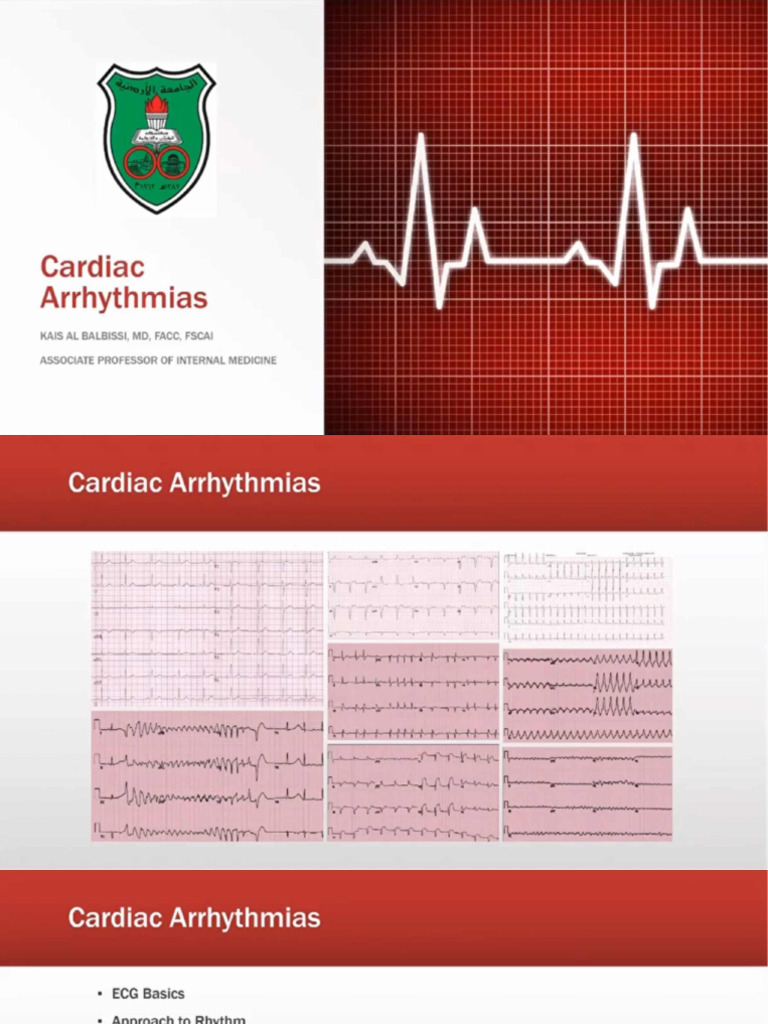 Cardiac Arrhythmias 3 | PDF
