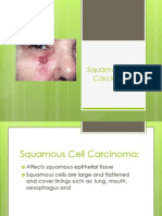 Squamous Cell Carcinoma