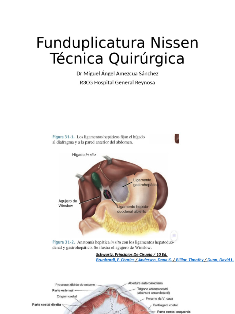 funduplicatura-nissen-t-cnica-quir-rgica-pdf