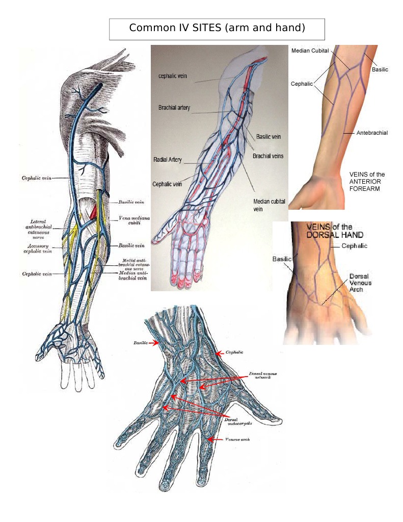Common IV Sites: Arm & Hand Guide | PDF