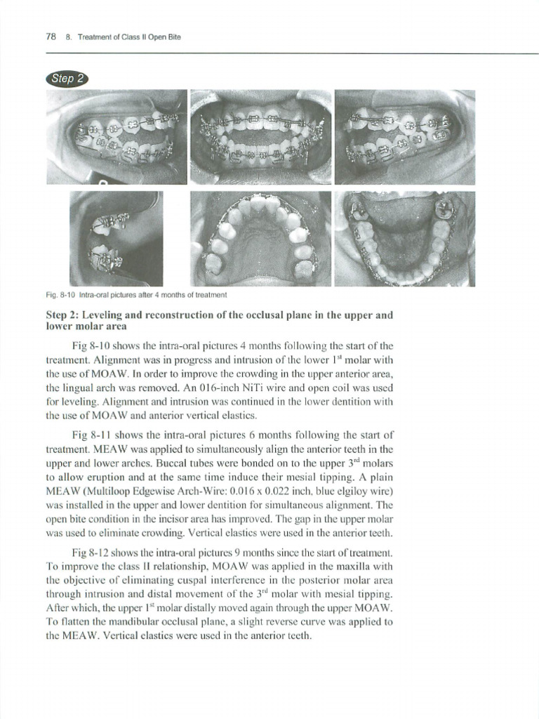 Manual For The Clinical Application of MEAW Technique-Trang-16 | PDF