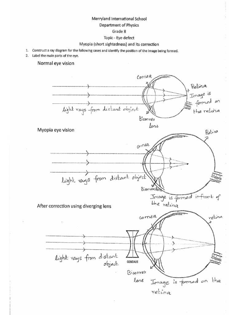 Eye Defects Correction | PDF