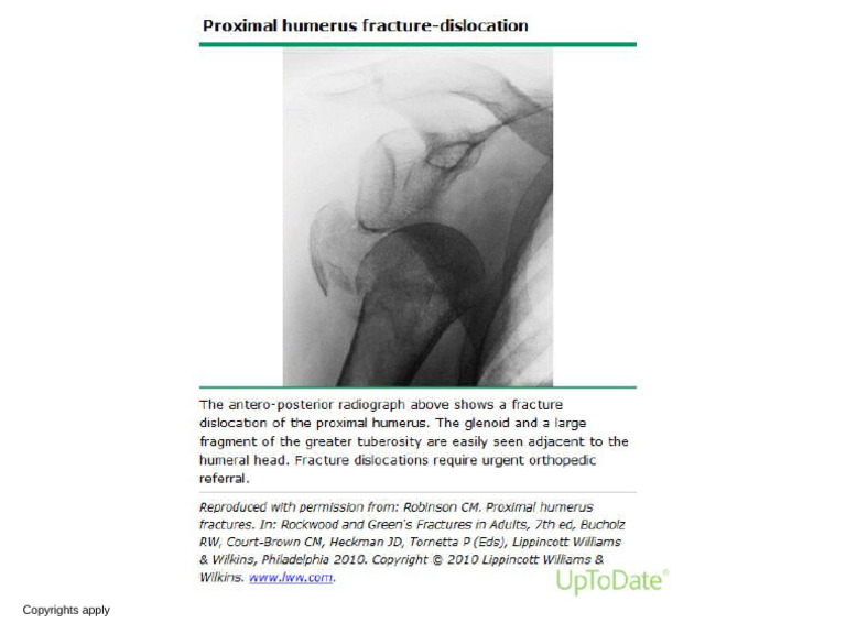 Proximal Humerus Fracture Dislocation | PDF