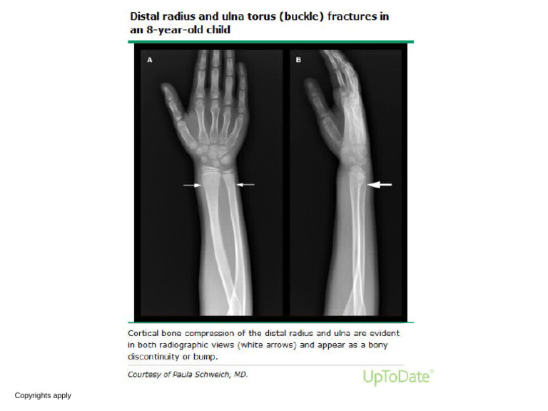 Buckle Fracture Radius Ulna | PDF