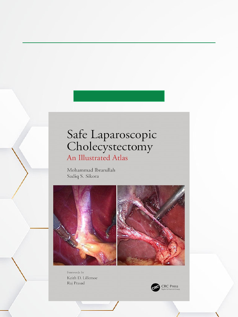Safe Laparoscopic Cholecystectomy Guide | PDF | Gallbladder | Liver