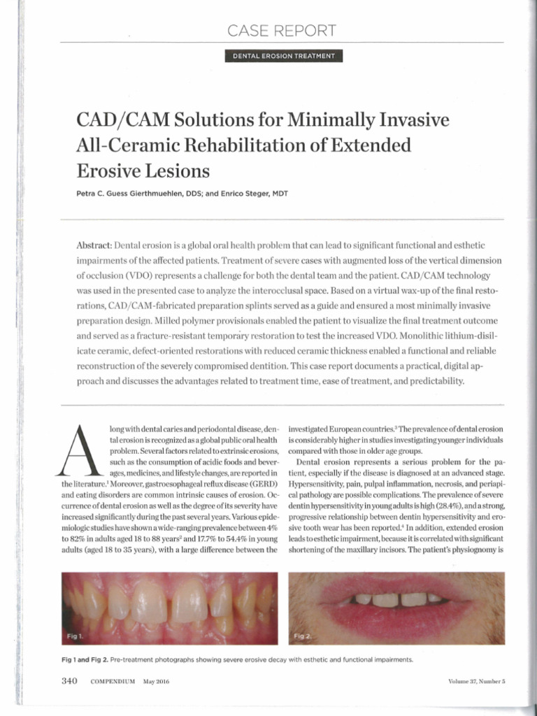 CADCAM Solutionsfor Minimally Invasive All Ceramic Rehabilitation of ...