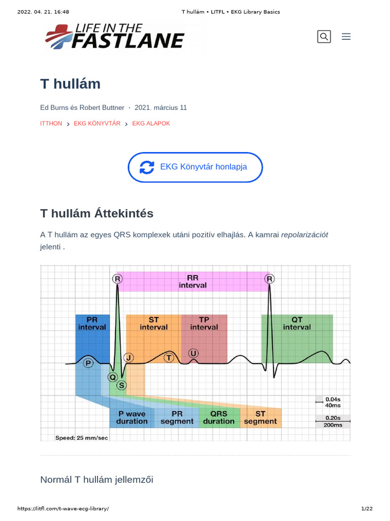 T Hullám - LITFL - EKG Library Basics | PDF
